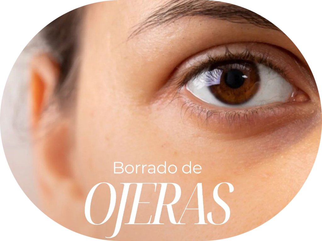 Borrado de ojeras