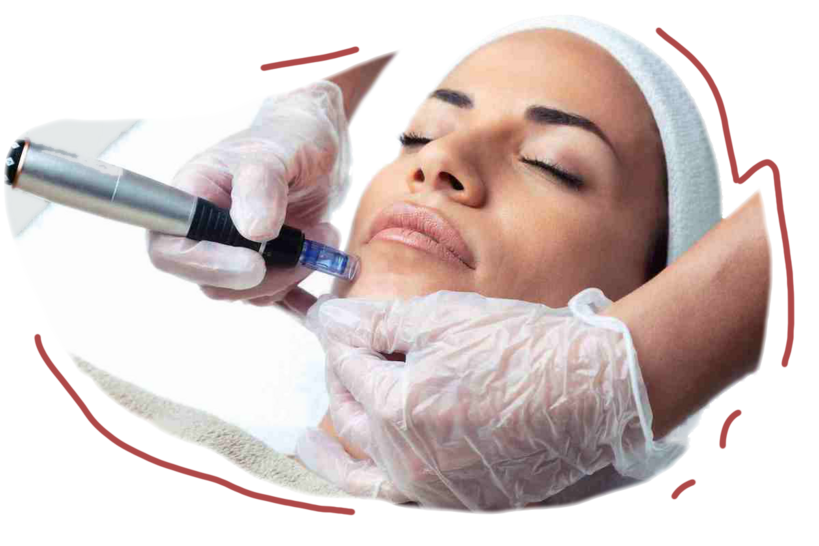 Mujer recibiendo tratamiento dermapen